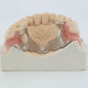 Stellitte de 1 a 14 dents dents